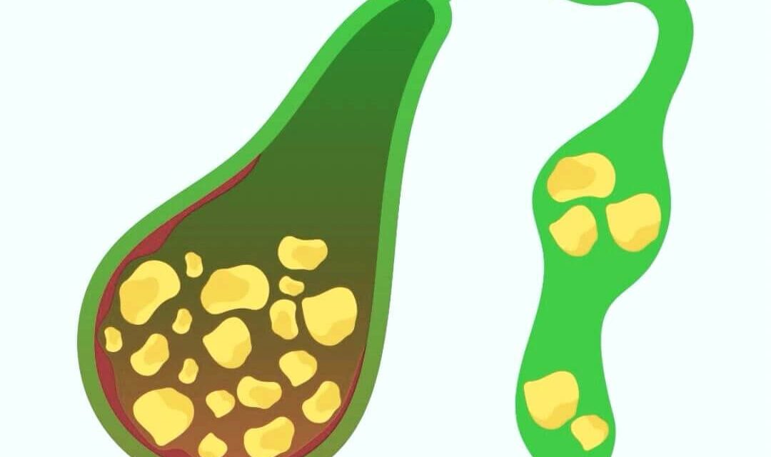 Cholestasis – Most Common Symptoms and How to Recognize It